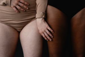 stretchmarks
